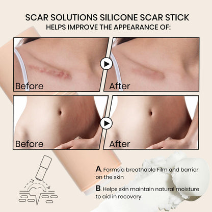 Silicone Scar Stick
